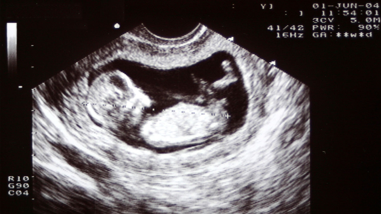 ULTRASOUND SCAN